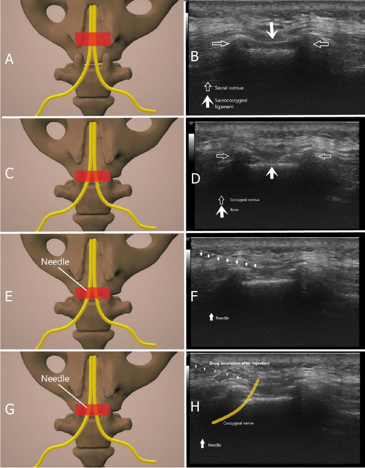 Coccygeal Nerve Blockade vs. Impar Ganglion Blockade in Coccydynia: A ...