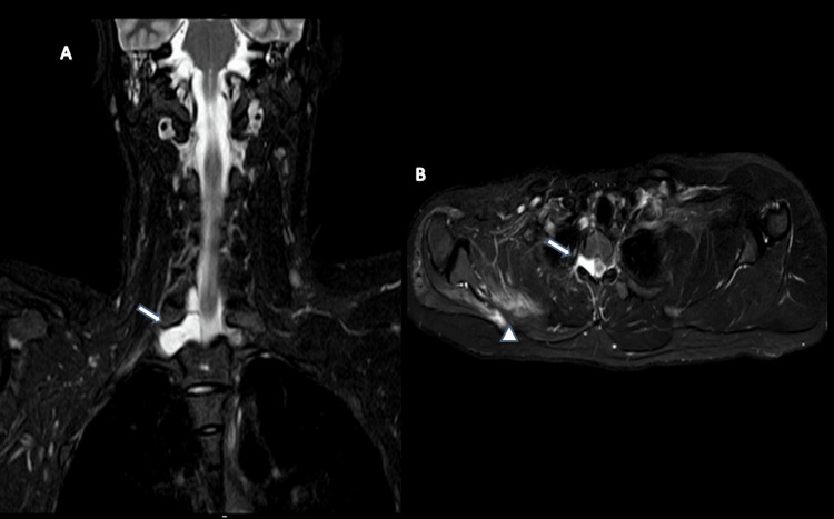 Traumatic Brachial Plexus Root Avulsion With Pseudomeningocele: A Case ...