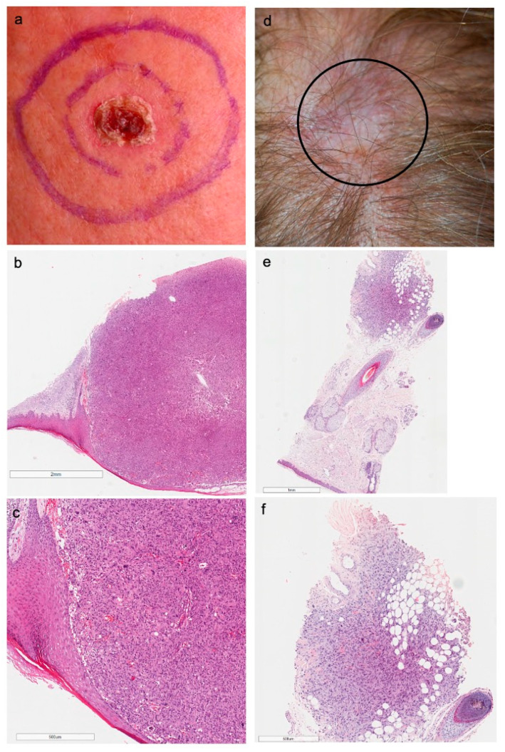 Clinicopathological and Genomic Profiles of Atypical Fibroxanthoma and ...