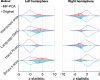 Histograms of z score magnitude for the original data and Marchenko-Pastur principal component analysis (MP-PCA) denoised data in eight regions of interest (data are from all 23 patients): the left and right Broca area, the left and right hand knob, the left and right language or presupplementary motor area (SMA), and left and right Wernicke area. Vertical lines show distribution medians. Histogram outlines correspond to all voxels within the spherical regions of interest. Shaded histograms correspond to regions of interest based on the first principal component. Histogram outlines are normalized to have an area under the curve of 1 standard deviation, and shaded histograms are normalized to the number of voxels included in the respective region of interest. Shaded areas in the right hemisphere and in motor regions are small because there are fewer highly correlated voxels in these areas compared with the left hemisphere language–dominant regions. Denoising widens the tails of these distributions, and in areas where task-related activation is increased, there is an outward shift in distribution median. There are shifts in the opposite direction in the right hemisphere due to task lateralization in the brain in contralateral regions.