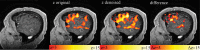Z statistic maps from the sentence-completion functional MRI task for a representative patient (38-year-old man) with a glioblastoma in the posterior left middle temporal gyrus near receptive language regions. From left to right, the images shown are a magnetization-prepared rapid gradient-echo image with no overlay followed by the original activation map (z original), the denoised activation map (z denoised), and the areas of difference between denoised and original activation maps (difference).