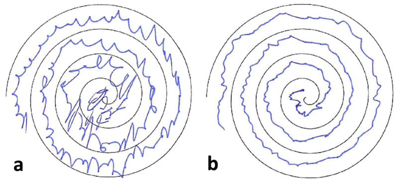 Visualization of the patient’s tremor during Archimedian spiral drawing