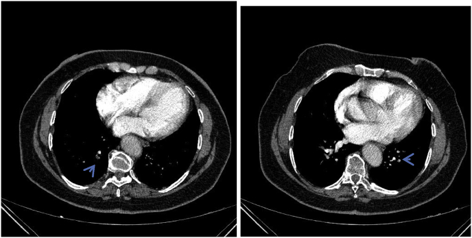 Troublesome Cough As The Sole Manifestation Of Pulmonary Embolism Pmc