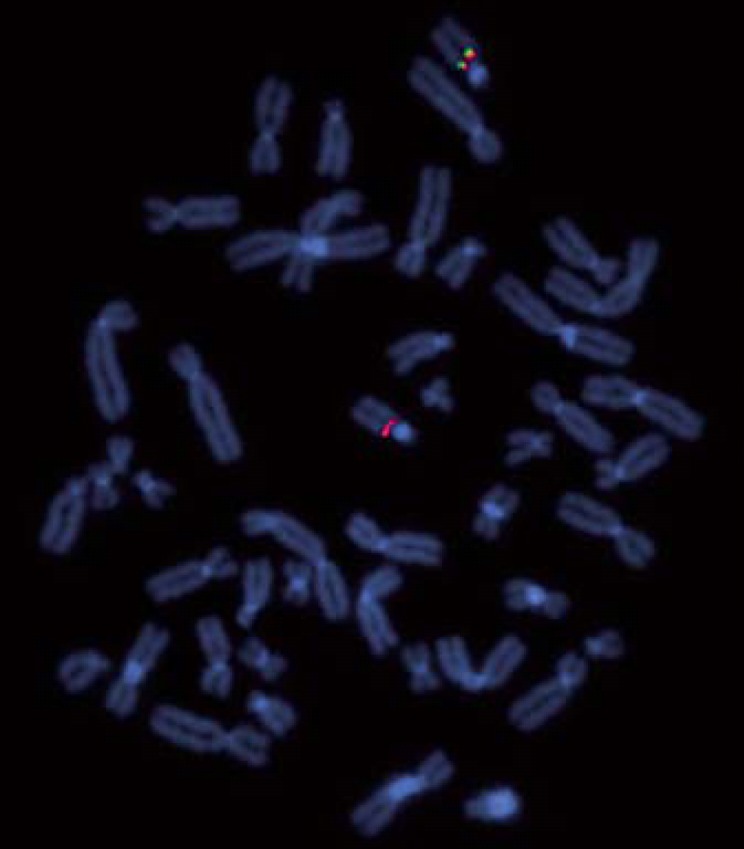 Clinical and Genetic Heterogeneity of the 15q13.3 Microdeletion ...