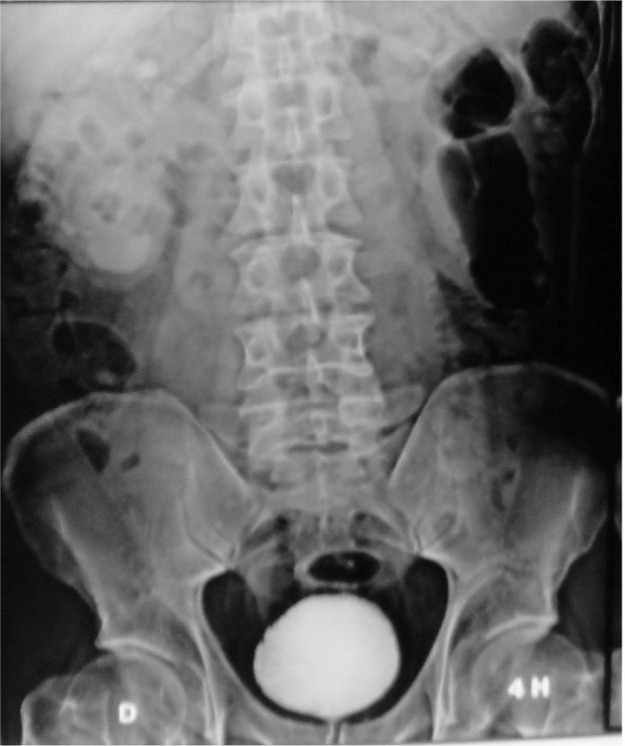 A case report of a giant bladder stone 12 8 cm 610 g pmc