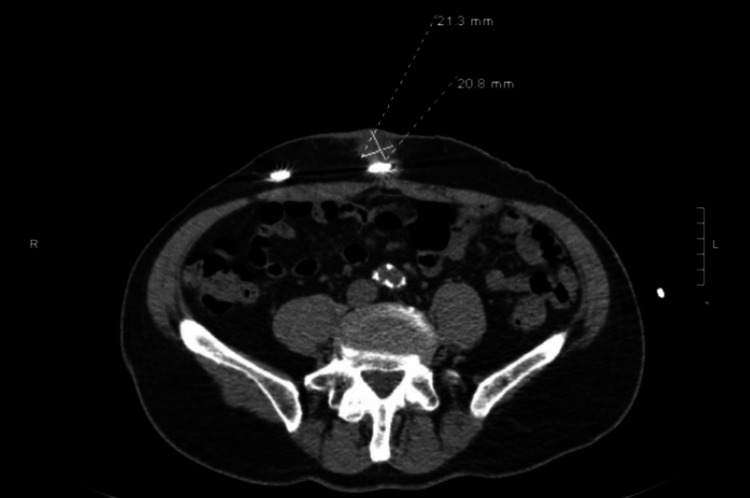 Mycobacterium Abscessus Infection In Left Ventricular Assist Device 