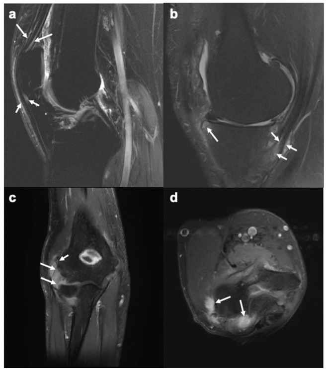 Magnetic Resonance Imaging of Enthesitis in Spondyloarthritis ...