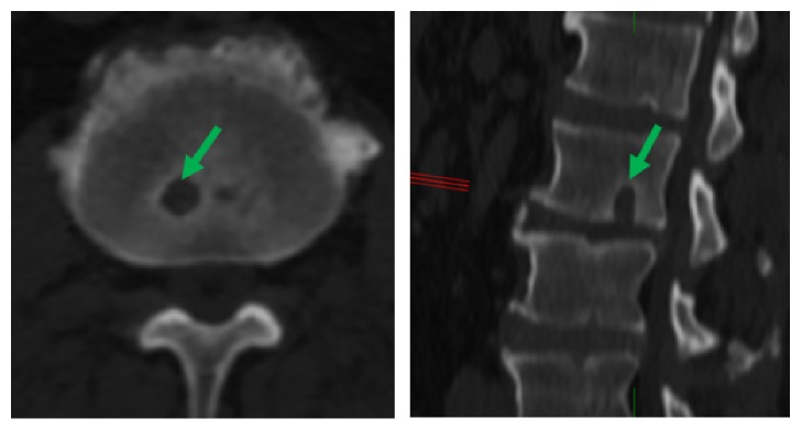 Lumbar Schmorl's Nodes and Their Correlation with Spine Configuration ...