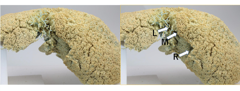 Demonstration of the right-side boundary of the caudate lobe in a liver ...