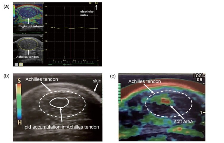 Fig.1. Quantitative ultrasound images obtained during elastography of Achilles tendon of patients with familial hypercholesterolemia