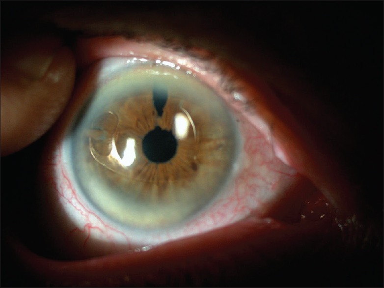 Iris-claw intraocular lens implantation: Anterior chamber versus ...