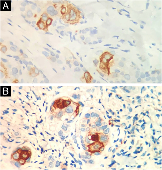 Squamoid eccrine ductal carcinoma: series of five cases of a rare tumor ...