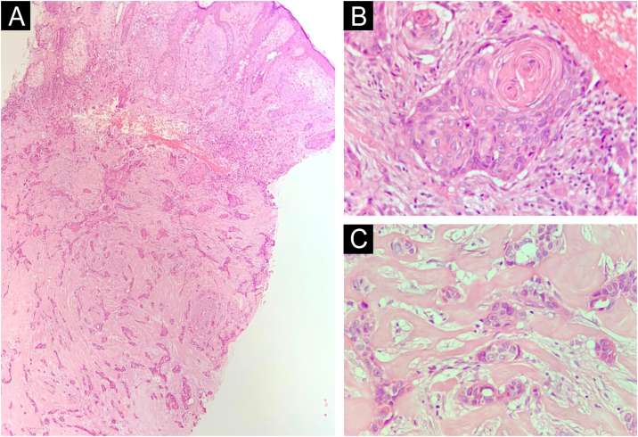 Squamoid eccrine ductal carcinoma: series of five cases of a rare tumor ...