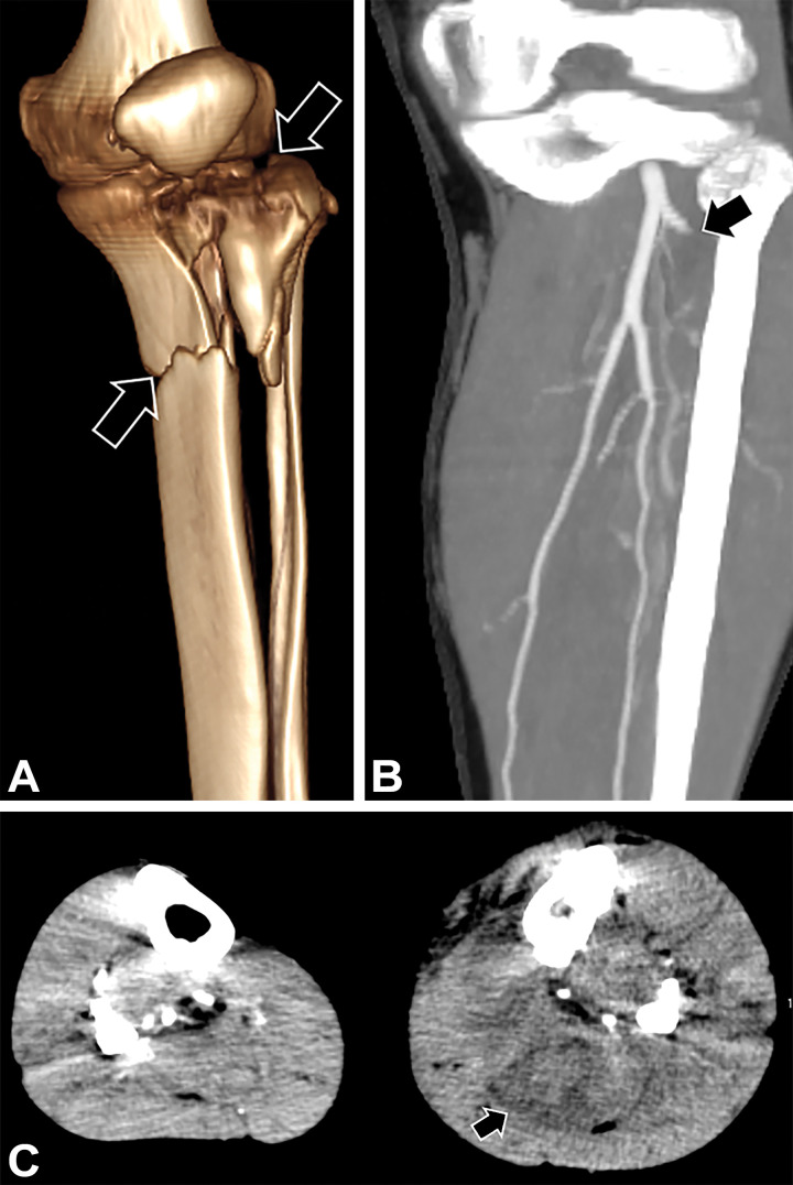 Crush injury to the distal left leg and clinical signs of compartment syndrome in a 39-year-old man. (A) 3D VR image shows a comminuted proximal tibial fracture (arrows). (B) Coned-down coronal MIP CTA image of the below-the-knee arterial runoff shows occlusion of the left anterior tibial artery (arrow) shortly beyond its origin. (C) Axial MIP CTA image of the lower legs shows enlarged edematous calf musculature (arrow) in the left lower extremity, compatible with clinically suspected compartment syndrome. Compartment pressures measured approximately 80 mm Hg. Four-compartment fasciotomy was performed.