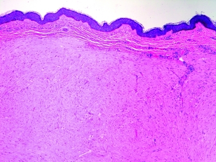 Reed's Syndrome: A Case of Multiple Cutaneous and Uterine Leiomyomas - PMC