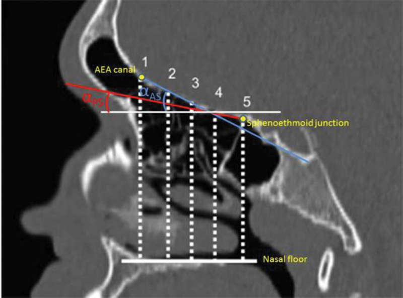 Radiological Anatomy of the Olfactory Fossa: Is Skull Base Anatomy ...