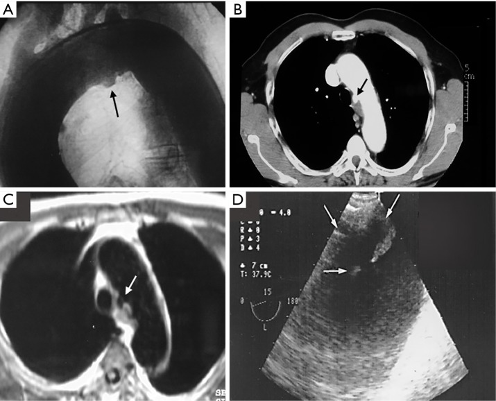 Intramural hematoma and penetrating ulcer in the descending aorta ...