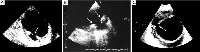 Intramural hematoma and penetrating ulcer in the descending aorta ...