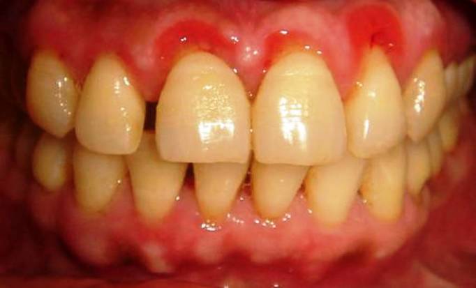 Multiple Mandibular Exostoses: A Rare Case Report - PMC