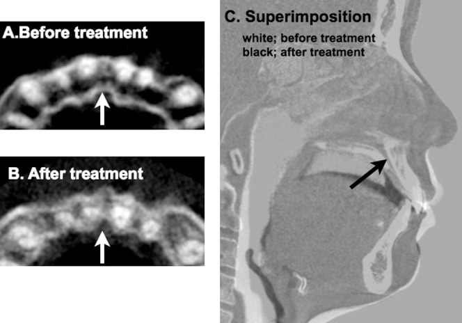 Figure 1. Cone beam computed tomography (CBCT) images of the incisive canal and superimposition before and after anterior retraction. Axial sections of the maxillary anterior region representing the apical one third of the maxillary incisors before (A) and after (B) anterior retraction. Notice the contact of the maxillary right central incisor and the approximation of the maxillary left central incisor roots to the incisive canal (arrow) after treatment. (C) CBCT superimposition on the cranial base before (in white) and after treatment (in black). Notice the changes in tooth position and the lateral profile following orthodontic treatment. No distinct changes were noted in the position of the incisive canal (arrow).