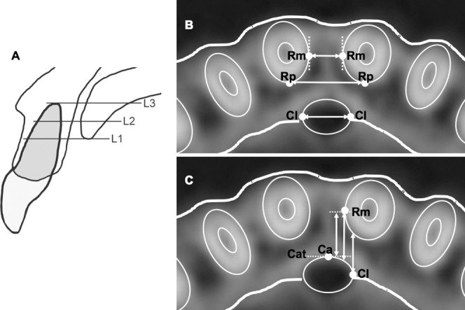 Figure 2. Landmarks and linear measurements. (A) Three vertical levels of the incisive canal: palatal opening level (L1), midlevel (L2), and root apex level (L3). (B) Landmarks for transverse measurements: Rm indicates the most medial point of the maxillary central incisor roots; Rp, the most posterior point of the maxillary central incisor roots; Cl, the most lateral point of the incisive canal; Rm-Rm, interroot distance; Rp-Rp, posterior interroot distance; Cl-Cl, canal width. (C) Landmarks for anteroposterior measurements: Ca indicates the most anterior point of the incisive canal; Cat, the tangent line through Ca; Rm-Cat, the distance from Rm to Cat; Rm-Canal, the distance from Rm to the anterior border of the incisive canal; Cl-Root, the distance from Cl to the posterior border of the maxillary central incisor root.