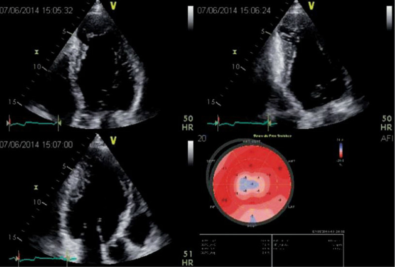 Four, Two and Three chamber 2D echo views where an apical aneurysm is showed