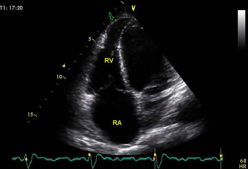 2D echo four chamber view shows a right ventricular aneurysm