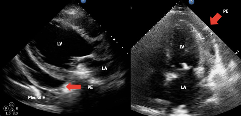 Views in two and four chambers of the LV where pericardial effusion is identified