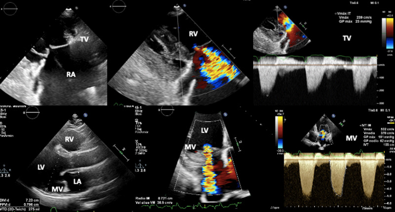 Echo Doppler evaluation of severe mitral and tricuspid functional regurgitation