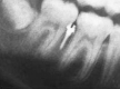 Figure 2. Apical radiograms showing the relationship of the adjacent roots and the temporary intraoral skeletal anchorage devices.