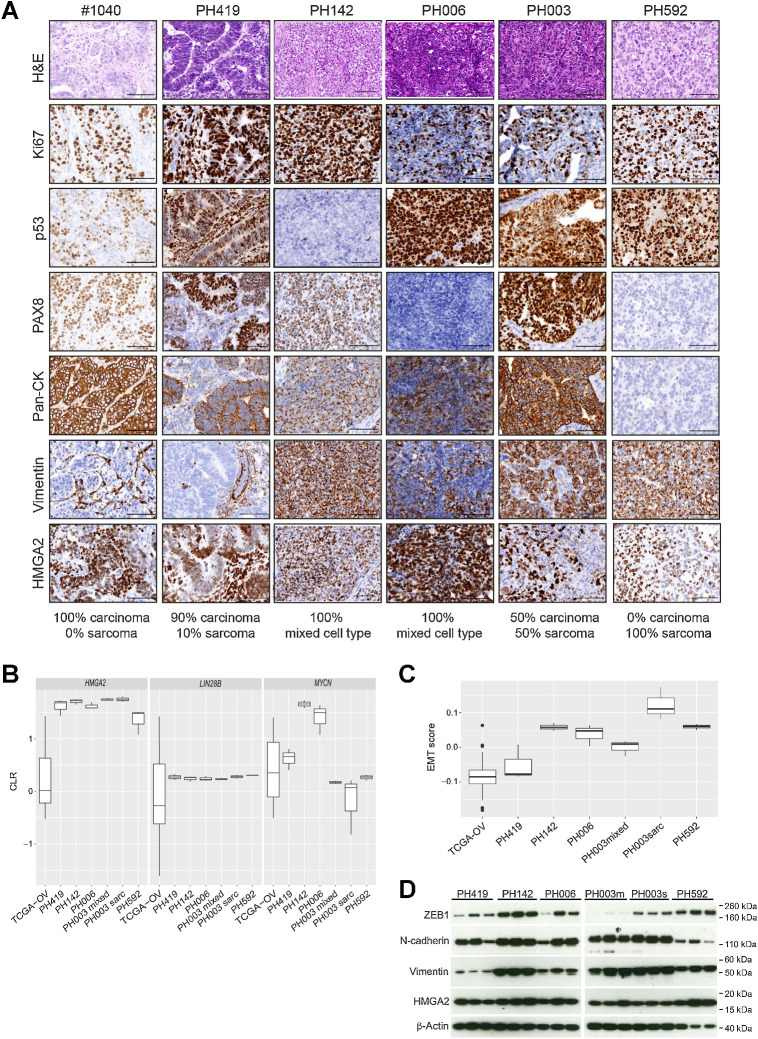 Figure 3. Characterization of PDX models of OCS with varying proportions of carcinoma and sarcoma. A, Tumors from each PDX model of OCS were assessed by IHC. Representative images of H&E, Ki67, p53, PAX8, pan-CK, vimentin, and HMGA2 staining are shown. Scale bars, 100 μm. Proportions of carcinoma and sarcoma in each model, as assessed by a gynecological pathologist, are indicated below the images. #1040 and PH419 were almost purely carcinoma; PH142, PH006, and PH003 were mixed with both carcinomatous and sarcomatous characteristics (i.e., expressing both pan-CK and vimentin), and PH592 was purely sarcomatous, with some epithelial characteristics (i.e., pan-CK co-expression in some cells). B, Expression of HMGA2, LIN28B, and MYCN was determined from RNAseq data for each OCS model (n = 3) compared with ovarian HGSC samples in TCGA (n = 379). C, EMT scores generated from RNA-seq data for tumors from each OCS PDX model are shown compared with EMT scores for ovarian HGSC samples in TCGA. D, Expression of the mesenchymal markers ZEB1, N-cadherin, vimentin, and HMGA2 in tumors from each OCS PDX model was determined by Western blot analysis. β-Actin was used as a loading control. CK, cytokeratin; CLR, centered log ratio; PH003m, PH003mixed; PH003s, PH003sarc.