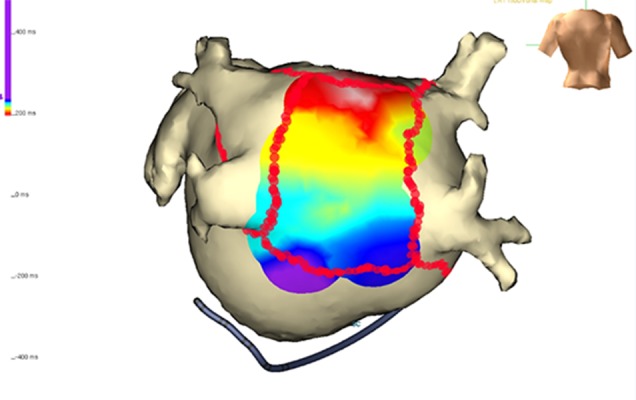 Complete Isolation of the Left Atrial Posterior Wall (Box Lesion) to ...