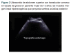 Figura 2 Ultrasonido de abdomen superior con transductor convexo en escala de grises en paciente mujer de 13 años. Se muestra imagen lineal hiperecogenica que proyecta sombra acustica posterior.