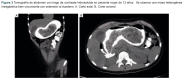 Figura 3 Tomografia de abdomen con trago de contraste hidrosoluble en paciente mujer de 13 años. Se observa una masa heterogenea intragástrica bien circunscrita con extensión al duodeno. A. Corte axial. B. Corte coronal.