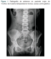 Figura 1 Radiografia de abdomen en paciente mujer de 13 años. Se muestra radiopacidad en fundus, cuerpo y antro gastrico.