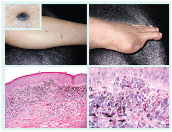 Current concepts of metastasis in melanoma - PMC