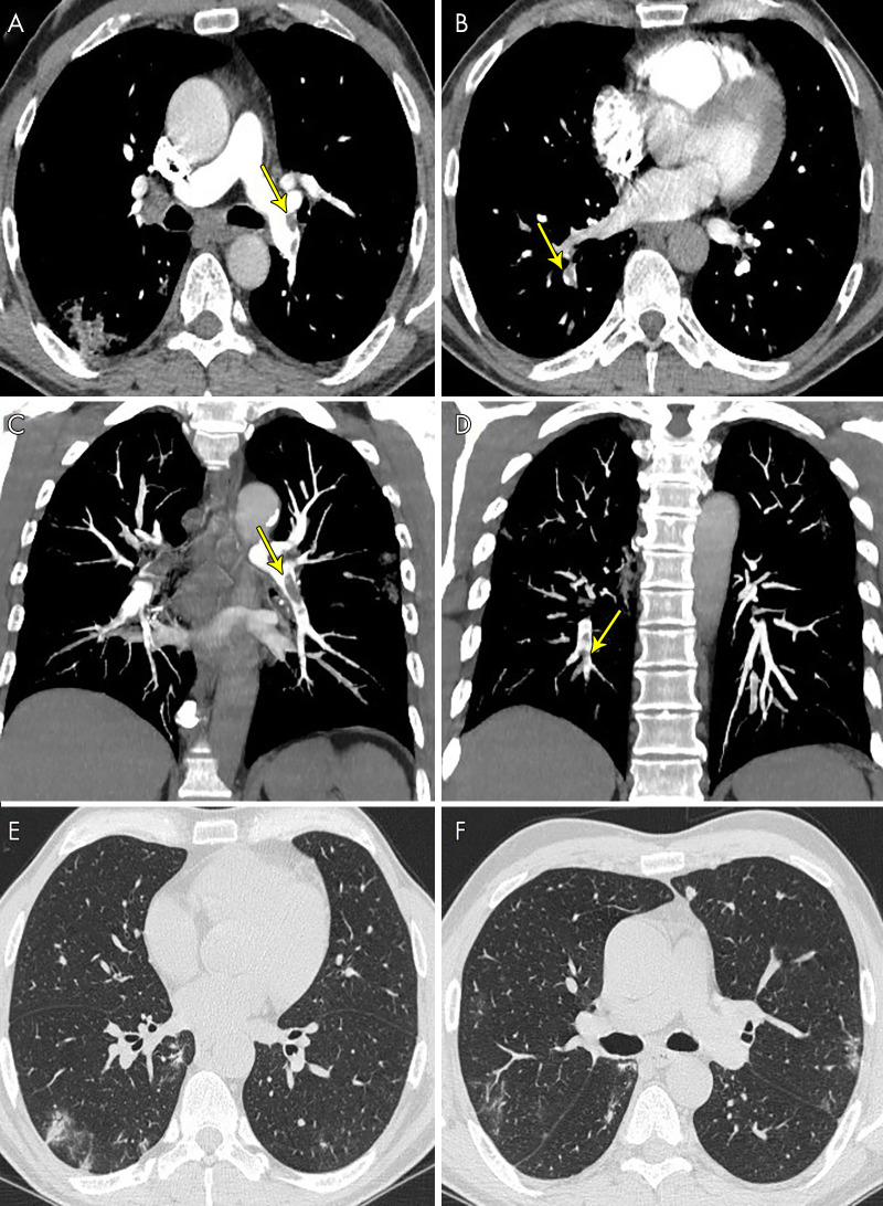 A 63-year-old man, after 17 days of hospitalization without respiratory support, had a sudden increase in d-dimer value. The images show pulmonary thromboembolism, A, in the lobar arteries for the left lower lobe (yellow arrow) and, B, in the segmental arteries for the right lower lobe (yellow arrows), C, D, confirmed by maximum intensity projection reconstructions (yellow arrows). E, F, Lung parenchyma is characterized by some peripheral subpleural bilateral ground-glass opacities and consolidations.