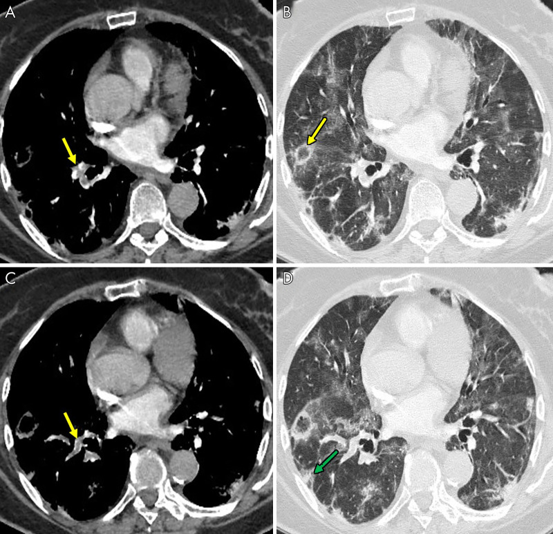 An 85-year-old man, after 16 days of hospitalization in the intensive care unit with invasive ventilation, had a sudden increase in d-dimer value. The images show, A–C, pulmonary thromboembolism in the segmental arteries for the lower right lobe (yellow arrows). B, Lung parenchyma is characterized by reverse halo sign (yellow arrow) and, D, diffuse ground-glass and peripheral subpleural wedge-shaped consolidation in lower lung lobe (green arrow).