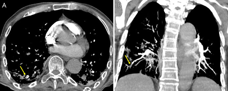 A 71-year-old woman, after 21 days of hospitalization with noninvasive ventilation, had sudden dyspnea and an increase in d-dimer value. The images show, A, pulmonary thromboembolism in the segmental and subsegmental arteries for the lower right lobe (yellow arrow), B, confirmed by a maximum intensity projection reconstruction (yellow arrow).