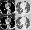An 85-year-old man, after 16 days of hospitalization in the intensive care unit with invasive ventilation, had a sudden increase in d-dimer value. The images show, A–C, pulmonary thromboembolism in the segmental arteries for the lower right lobe (yellow arrows). B, Lung parenchyma is characterized by reverse halo sign (yellow arrow) and, D, diffuse ground-glass and peripheral subpleural wedge-shaped consolidation in lower lung lobe (green arrow).