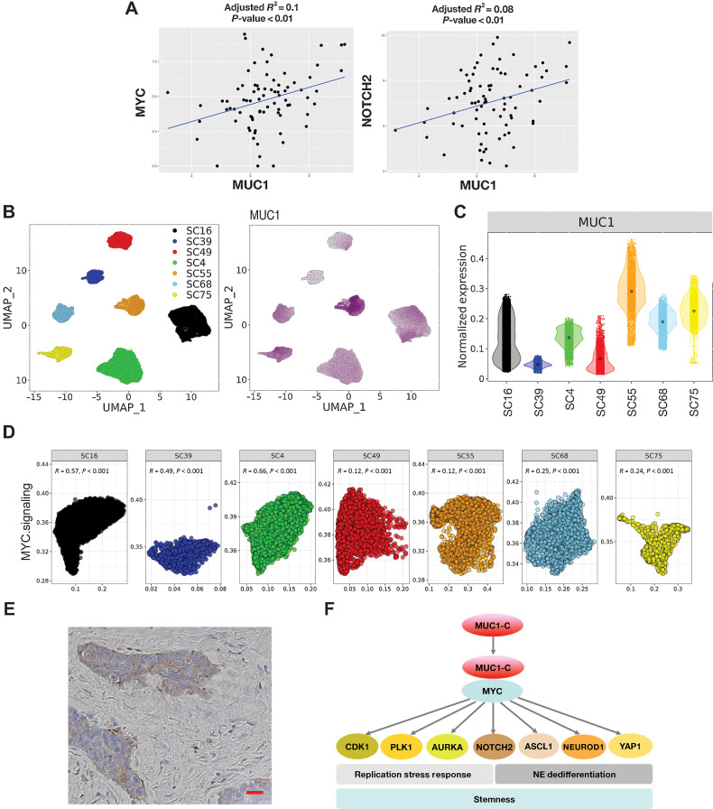 Figure 7. Expression of MUC1 in SCLC tumor tissues. A, Analysis of the GSE60052 SCLC bulk RNA-seq dataset demonstrating significant correlations of MUC1 with MYC and NOTCH2 expression in SCLC tumor tissues. B, Analysis of the GSE138267 SCLC scRNA-seq dataset demonstrating MUC1 expression in clusters of SCLC cells obtained from seven patient-derived CDX models. C, Distribution of MUC1 expression in the seven CDX models. D, Significant associations of MUC1 expression with activation of the HALLMARK MYC TARGETS V1 pathway in individual tumors. E, Representative IHC staining of MUC1-C expression in SCLC tumor tissue. Bar represents 50 μm. F, Proposed model for MUC1-C in driving SCLC progression. MUC1-C activates MYC and E2F target genes that contribute to the RSR and mitotic progression. MUC1-CgMYC signaling also drives expression of NOTCH2 and NE dedifferentiation. MUC1-C thereby integrates activation of the dysregulated MYC and E2F pathways and RSR with NE dedifferentiation, stemness, and self-renewal in SCLC cells.