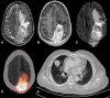 MRI and PET/CT images reveal a large left parietal meningioma with
necrosis, sinus invasion, and pulmonary metastases.
