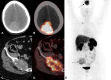 CT and PET/CT images reveal a right parietal meningioma with an
avid iliac bone metastasis.