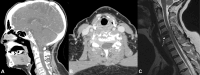 Imaging reveals a C5 vertebral lesion in a patient with prior
frontoparietal meningioma, confirmed as metastatic.