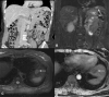 Imaging demonstrates a DOTATATE-avid hepatic lesion in a patient
with prior resected meningioma, confirmed as metastasis.
