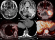 Imaging shows a left occipital meningioma with bone destruction
and DOTATATE-avid pulmonary and spinal metastases.