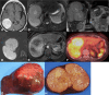 MRI and PET/CT images show recurrence of right parietal meningioma
with a large DOTATATE-avid hepatic metastasis.