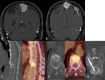 MRI, CT, and PET/CT demonstrate a parafalcine meningioma with
vertebral metastasis confirmed by biopsy.