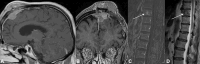 Spinal and brain imaging shows recurrence of left frontal
meningioma with vertebral metastasis.