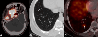 PET/CT and CT images show intense tracer uptake in a right
sphenoid wing meningioma with bilateral pulmonary nodules, consistent
with metastatic meningioma.